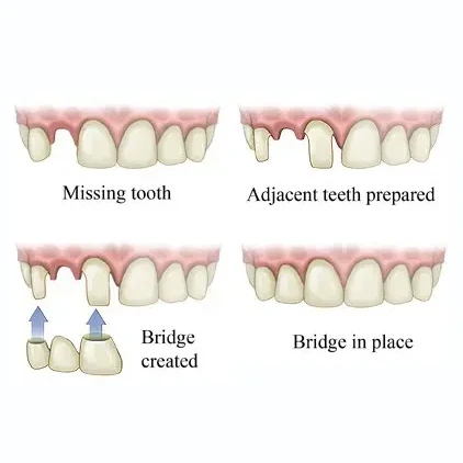 helpful images of dental bridges orange county