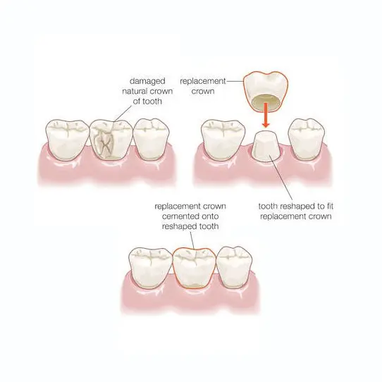 helpful images of dental crowns orange county