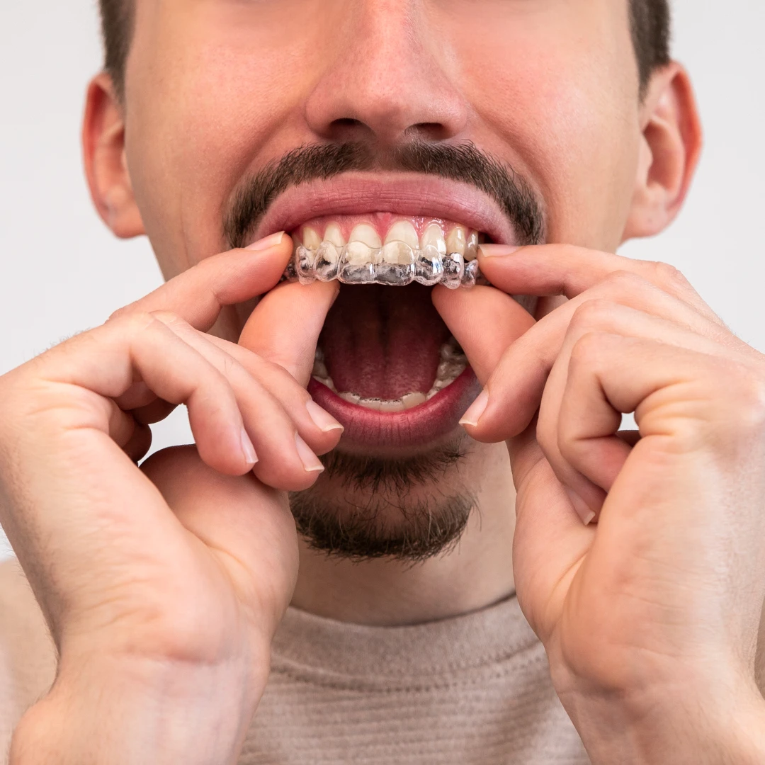 man putting on clear teeth aligners to straighten his teeth without braces | Clear Aligners Orange County